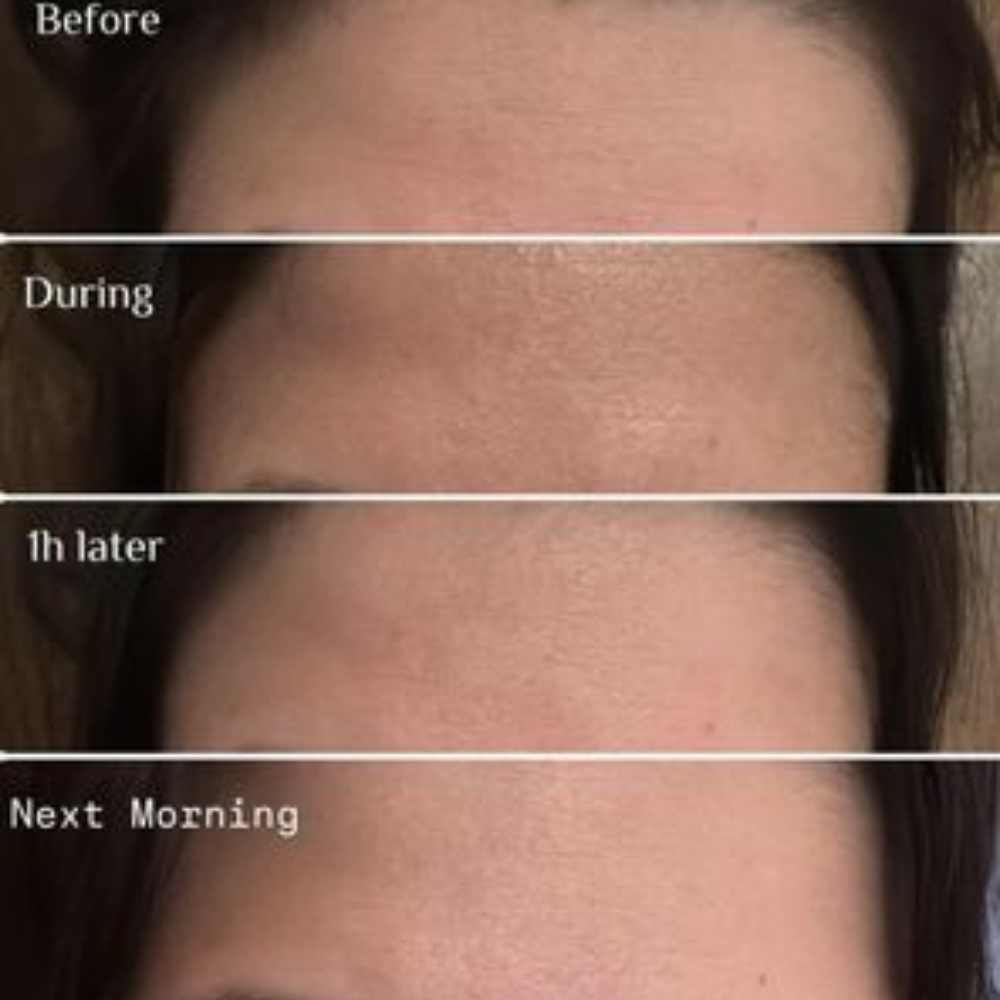 Anti Aging Micro Infusion treatment DERMALAB resultaat